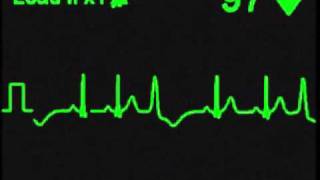 Ventricular Trigeminy  ECG SImulator  Arrhythmia Simulator [upl. by Alvie]