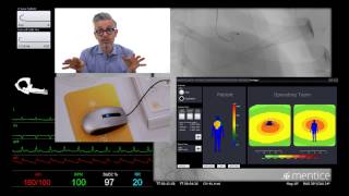 Circumflex Artery Angioplasty [upl. by Erot]