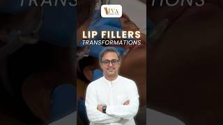 Lip Fillers Transformation by Dermatologist  before amp after  Dr Deepam Shah [upl. by Hebe]