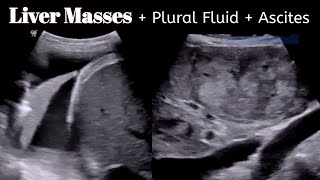 Liver masses  Cancer   Pleural FLuid  Ascites  Ultrasound [upl. by Ayar]