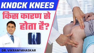 Knock Knees किस कारण से होता है  Knock Knee Problem  Vikram Mhaskar [upl. by Emrich]