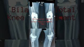 Ortho Case orthopedics radiology anatomy discbulge TKRphysiotherapy [upl. by Stephenie]