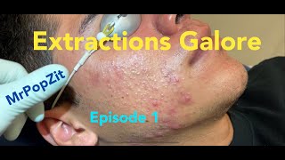 Acne Extractions Galore part 1Ingrown hairs blackheads whiteheadsLoop extractorQtipsMrPopZit [upl. by Asiulairam]