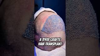 Thinning hair Hair loss advancing Consider a hair transplant vincihairclinic shorts [upl. by Boesch587]