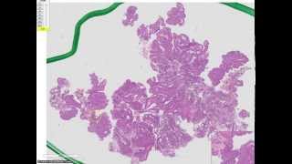 High grade papillary urothelial carcinoma Grade 3 TCC [upl. by Rahas]