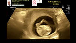 Omphalocele 11 weeks [upl. by Annavaig]