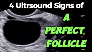 A Perfect Follicle  4 Ultrasound Signs  of Good Follicle for Easy Conceiving [upl. by Briney]