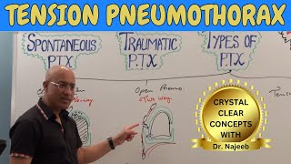 Tension pneumothorax  Causes Clinical Correlations  Emergency Treatment🩺 [upl. by Larimer586]