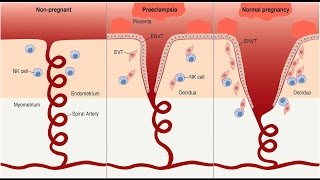 Preeclampsia Pathophysiology [upl. by Inod]