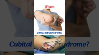 Cubital tunnel syndrome Ulnar neuropathy at the elbow shorts osborneband [upl. by Myke]