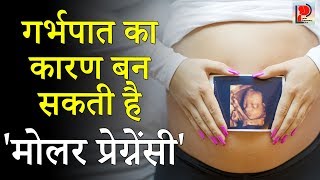 Molar Pregnancy  प्रेगनेंसी में मोल क्यों बनता है  why amp how mole develops in pregnancy [upl. by Perkin522]