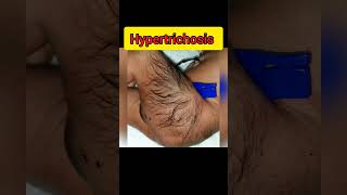 HypertrichosisExcessive hairiness [upl. by Ylahtan]