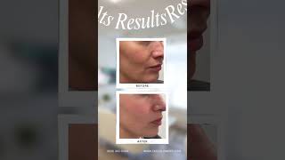 POWERFUL NONSURGICAL FACE LIFT TRY FOTONA 4D AT FACE GLOW NYC ONLY 799 THIS MONTH [upl. by Bej102]