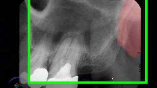 Proceso pterigoideo y apofisis hamular Pterygoid Plateshamular process [upl. by Sherie]