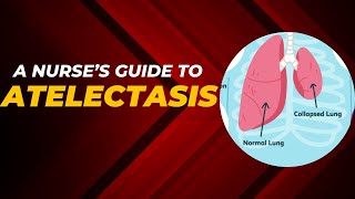 Atelectasis Definition Etiology Pathophysiology Classification Diagnosis and Management [upl. by Trefor806]