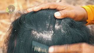 Extreme Dandruff Scratching Huge Flake And Dry Scalp Removal 63 [upl. by Kliment]