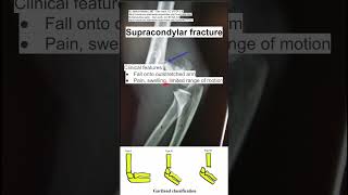 Supracondylar fracture [upl. by Merrick]