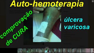 COMPROVAÇÃO DE CURA DE ÚLCERA VARICOSA PELA AUTOHEMOTERAPIA [upl. by Tenn]