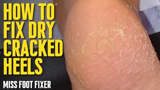 How to Treat Dry Cracked Heels 2022 full treatment by miss foot fixer aka marion yau [upl. by Iderf]