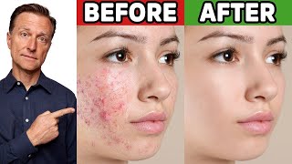 The Best Trick for Clear Skin Acne Aging Wrinkles Liver Spots [upl. by Ecnerolf130]