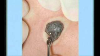 Seborrheic Keratosis Treatment [upl. by Yadsendew]