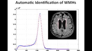 Resolving the White Matter Hyperintensity Prenumbra using FLAIR and Diffusion [upl. by Adlare]