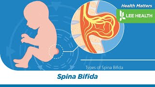 Spina Bifida [upl. by Manolo]