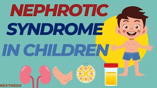 Nephrotic Syndrome In ChildrenCausesSigns And SymptomsDiagnosisTreatmentPaediatrics [upl. by Aramoix703]