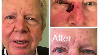 Eyelid Skin Cancer Reconstruction Surgery [upl. by Budwig]