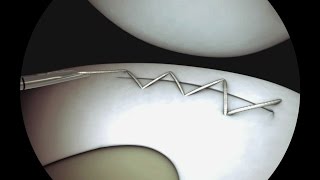 Sequential Meniscal Running Stitch Using Sequent®  CONMED Animation [upl. by Aihsal578]