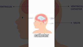 NPH symptoms diagnosis and treatment normal pressure hydrocephalus [upl. by Alvina156]