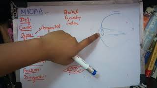 MYOPIA important concept made easy part 1 [upl. by Yztim356]