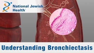 Understanding Bronchiectasis Overview and Clinical Features [upl. by Ware575]