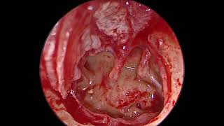 Endoscopic anatomy of middle ear structure [upl. by Ednihek878]