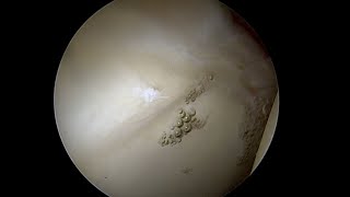 Debonded Articular Cartilage Lifting off the Bone as Labrum is Stressed [upl. by Erbe]