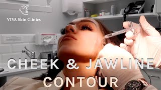 Cheek and Jawline Contour  VIVA Skin Clinics  Dermal Fillers [upl. by Manly]