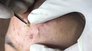 How To Remove Blackheads And Whiteheads On Face Easy 59 ✦ Dr Laelia ✦ [upl. by Valley372]