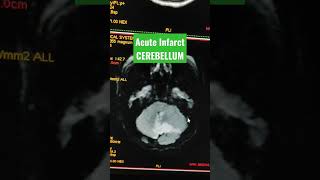 Large Acute Infarct in Cerebellum viral youtubeshorts mri [upl. by Jourdain]