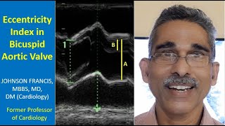 Eccentricity Index in Bicuspid Aortic Valve [upl. by Ahsenad289]