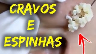 Como Remover Cravos do Rosto  Removendo CRAVOS e ESPINHAS GIGANTES 015 [upl. by Ellekcim197]