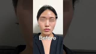 Korean Double Jaw Surgery  VLine Surgery  Zygoma Reduction Surgery Results  Before amp After [upl. by Yerffej148]