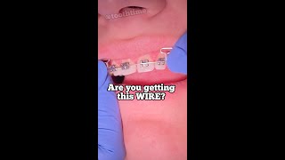 Braces On  What does a reverse curve wire do for braces Tooth Time Family Dentistry New Braunfels [upl. by Harwill]