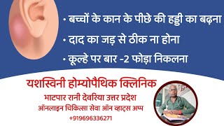 Mastoiditis  कान के पीछे की हड्डी का बढ़ना या गाँठ बनना  Kan Ke Pichhe Ki Haddi Badhna Ya Gaanth [upl. by Asirral820]