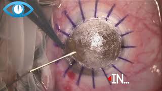 Deep anterior lamellar keratoplasty DALK Big Bubble Technique [upl. by Oflunra]