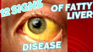 12 Signs You Have Fatty Liver Disease fattyliverdisease shorts liversdisease cirrhosis [upl. by Enylodnewg742]