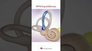 BPPV Cupulolithiasis  shorts [upl. by Matrona393]