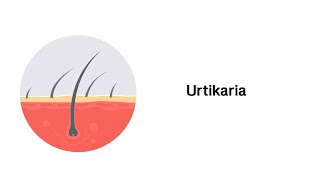 Nesselsucht Urtikaria  Erkrankungen der Haut [upl. by Leigh]