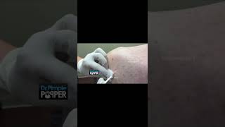 Disgusting or not drpimplepopper popaholics [upl. by Nwahsir]