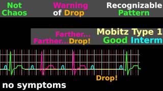 ECG Tutorial AV block EKG Mobitz electrocardiogram interpretation [upl. by Cave548]