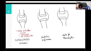 1Daño articular Osteoartritis o Artrosis OA Artritis infecciosa Gota y Pseudogota [upl. by Vial]